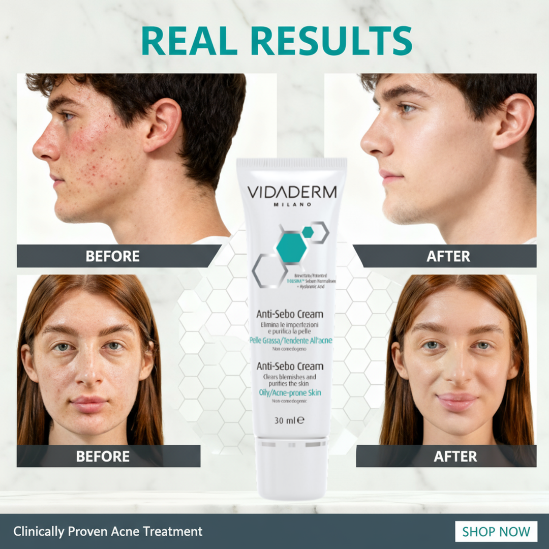 Vidaderm Anti-Sebo Treatment Cream | Reduce Oil by 34% in 14 Days