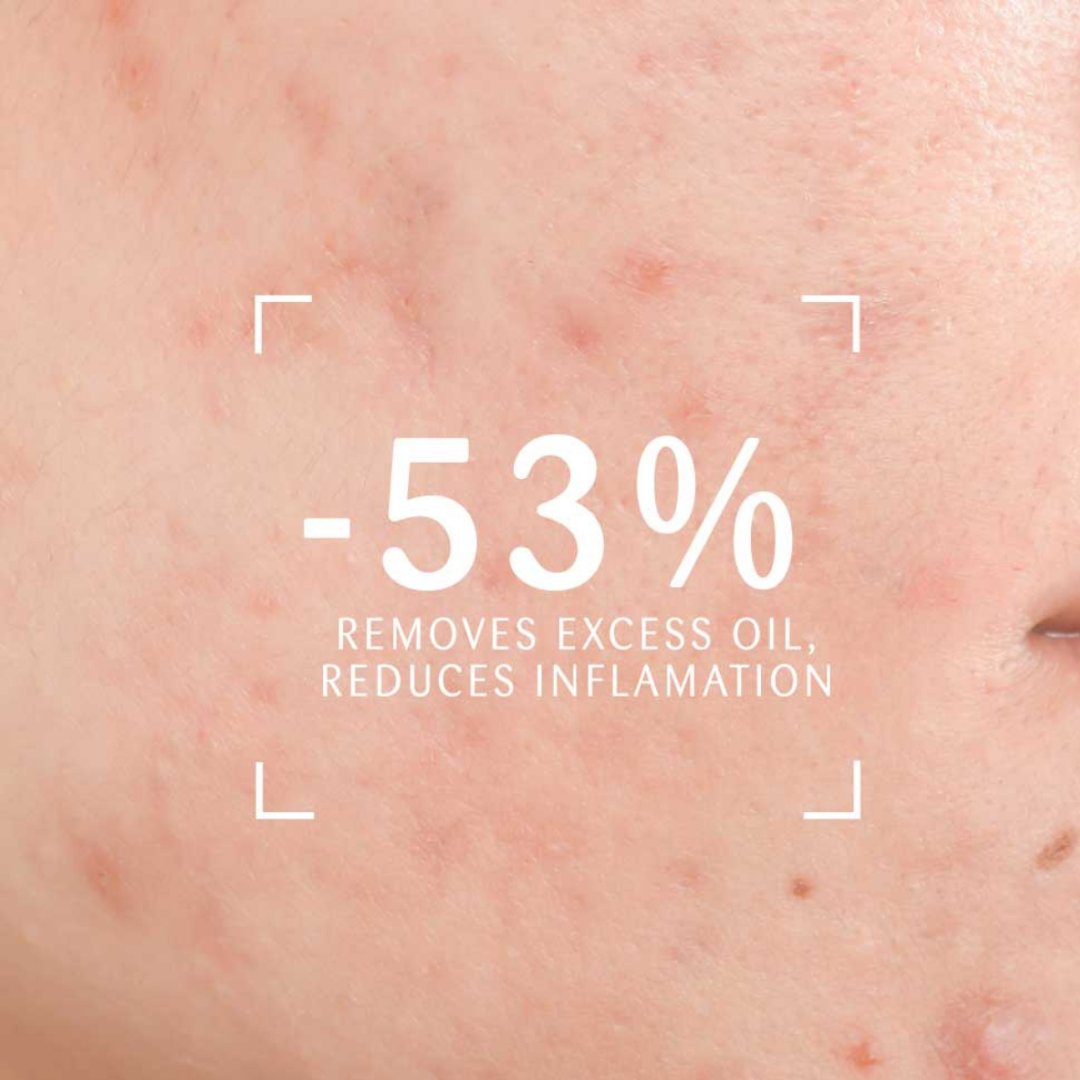 Vidaderm Clarifying Foaming Gel | Oil-Control Cleanser for Acne-Prone Skin